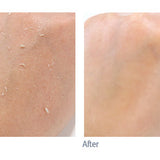 Peeling Gel